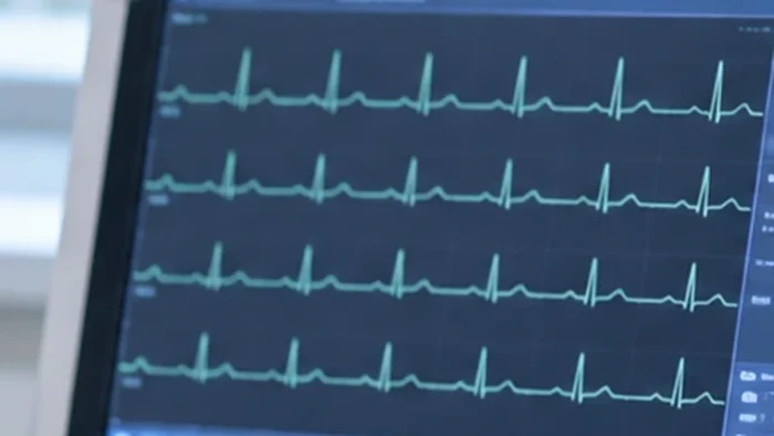 Mengenal EKG: Pemeriksaan Jantung yang Perlu Diketahui Masyarakat